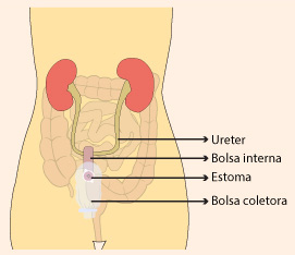 Urostomia